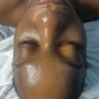 Acne Facial