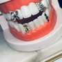 Teeth Whitening