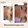 Oxygen Facial