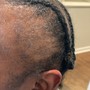 Scalp Treatment