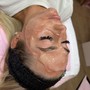 Dermaplaning