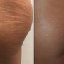 RF Tightening and Cellulite Treatment w/ Butt Lift