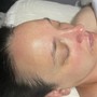 Microdermabrasion