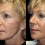 Back Medical Grade Facial