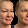 Acne Medical Grade Facial