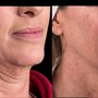 Scarlet RF MicroNeedling