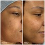 Acne Medical Grade Facial