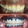 Advance teeth whitening