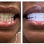 Advance teeth whitening