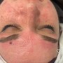 Microdermabrasion