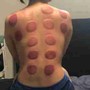 30 Min Cupping Therapy