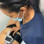 Dermaplaning