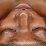 Radiance Renewal Microdermabrasion