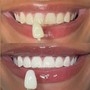 Teeth Whitening