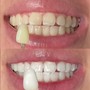 Teeth Whitening