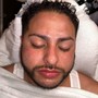 Micro-needling (Hair restoration)