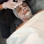 Acne Facial