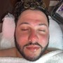 Light Depth Rejuvenation Peel