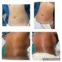 Non invasive Vacuum Therapy Butt Lift /Boob Lift