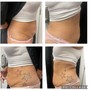 Meso Lipo Infusions