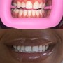 Teeth Whitening (Standard)