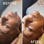 Facelift Facial