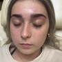 Microdermabrasion