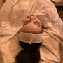 Microdermabrasion