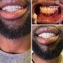 24k gold 40 MINUTES TEETH WHITENING