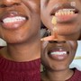 24k gold 40 MINUTES TEETH WHITENING