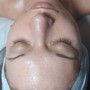 Oxygen Facial