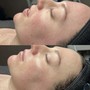 Neveskin Facial (Face Lift)