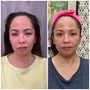 Neveskin Facial (Face Lift)