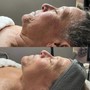 Neveskin Facial (Face Lift)