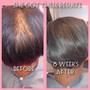 Scalp Treatment