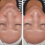 Chemical Peel