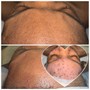 Dermaplaning