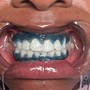 Advance teeth whitening