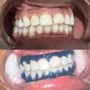 Advance teeth whitening