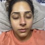 Oxygen Facial Treatment