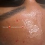 MicroNeedling