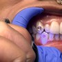 Tooth Gem Application