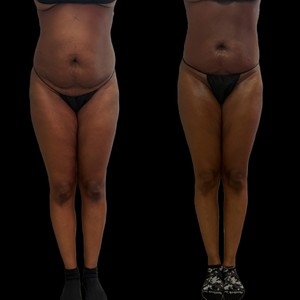 痩身サロンEVE  DetoSix Summer body season is here ✨ Body Cavitation now available at